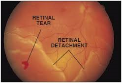 Retinal Detachment and Tear